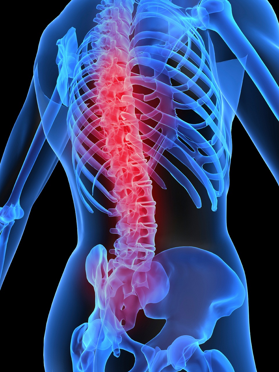 Ankylosing spondylitis